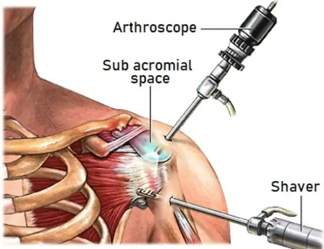 Arthroscopic Subacromial Decompression : 关节镜下肩峰下减压