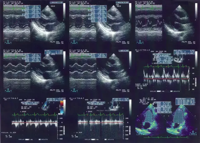 Asymptomatic Cardiac ischemia Pilot study : 无症状心脏缺血的初步研究