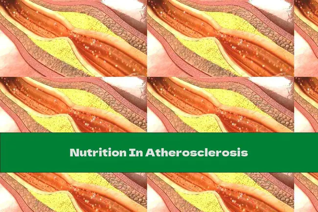 Atherogenic Diet : 动脉粥样硬化饮食