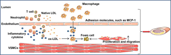 Atherogenic Metabolic Triad : 动脉粥样硬化代谢三联征