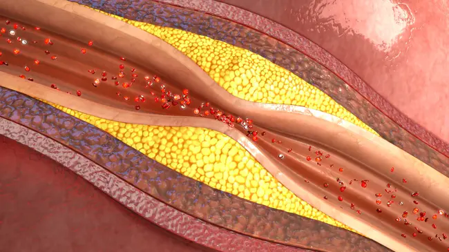 Atherosclerotic Coronary Disease : 动脉粥样硬化性冠状动脉疾病