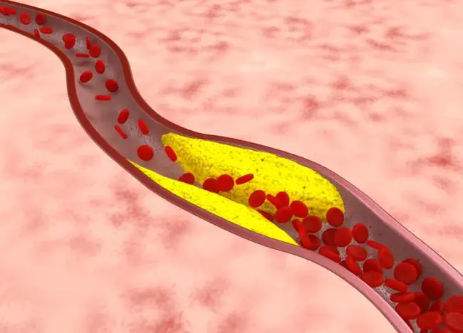 Atherosclerotic Index : 动脉粥样硬化指数