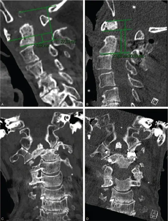 atlantoaxial subluxation : 寰枢椎半脱位