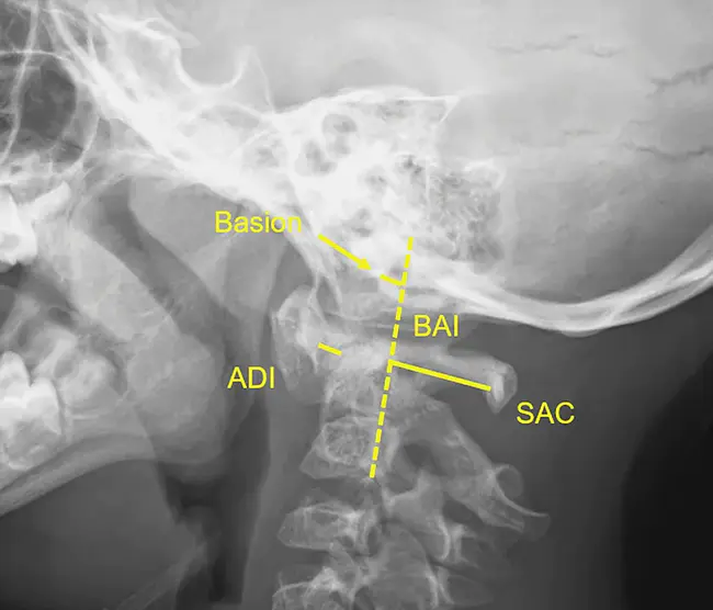 atlantodental interval : 寰齿间隙