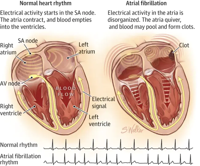 Atrial : 心房的