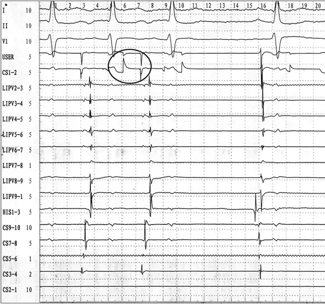 Atrial Reentrant Tachycardia : 心房折返性心动过速