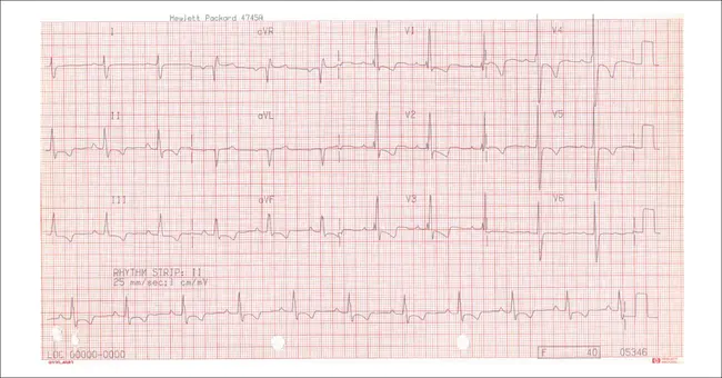 Atrial Septal Aneurysm : 房间隔动脉瘤