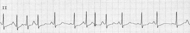 Atrial Tachycardia : 房性心动过速