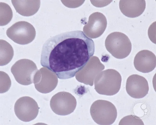 Atypical Lymphocyte : 非典型淋巴细胞