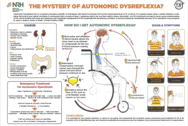Autonomic Dysreflexia : 自主神经反射异常
