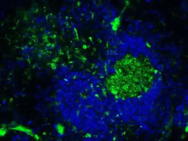 B lymphoblastic cells : B淋巴细胞