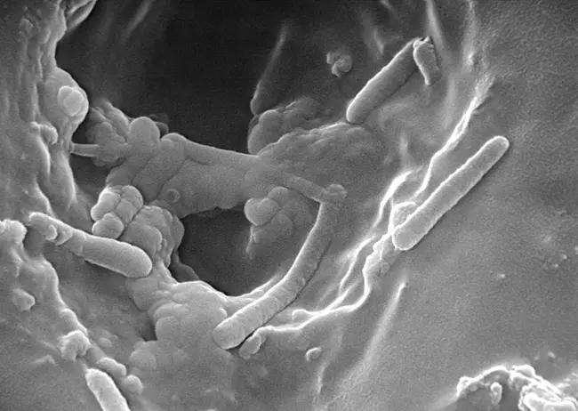 Bacterial Pneumonia : 细菌性肺炎