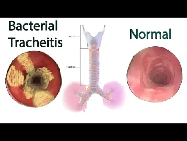 Bacterial Tracheitis : 细菌性气管炎