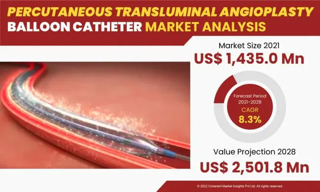 Balloon Catheter Angioplasty : 球囊导管血管成形术