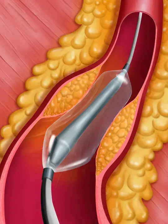 Balloon Pulmonary Angioplasty : 球囊肺血管成形术