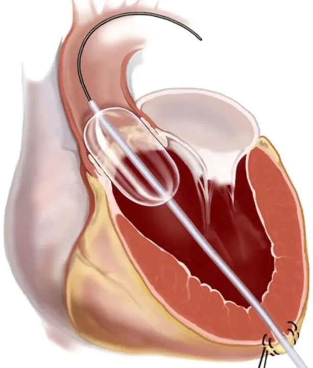 Balloon Valvuloplasty : 球囊瓣膜成形术