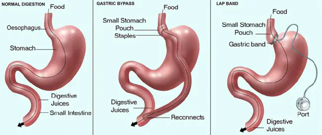 Bariatric Surgery : 减肥手术