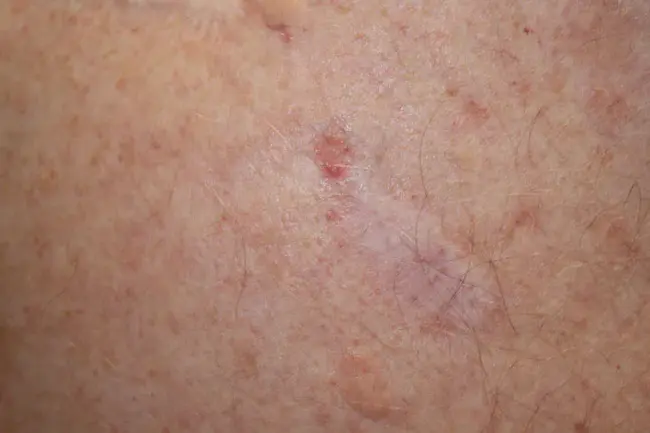 Basal Cell Adenoma : 基底细胞腺瘤