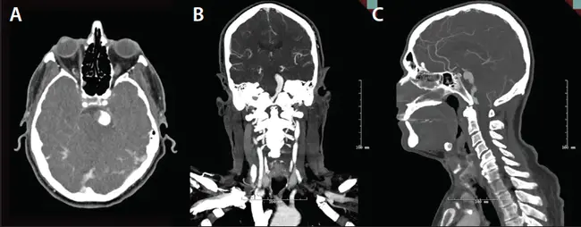 Basilar Artery Occlusion : 基底动脉闭塞