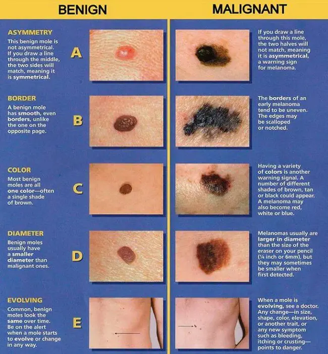 Benign Biliary Strictures : 良性胆道狭窄