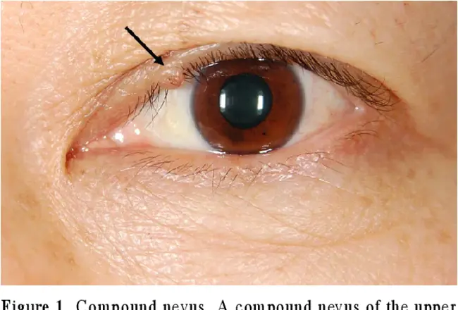 Benign Epithelial Tumour : 良性上皮瘤