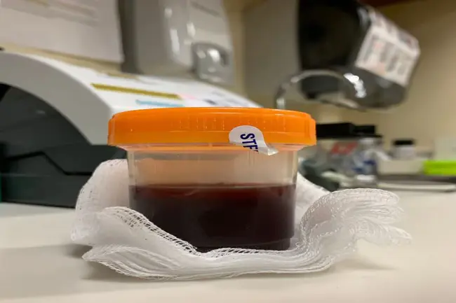 Benign Recurrent Haematuria : 良性复发性血尿