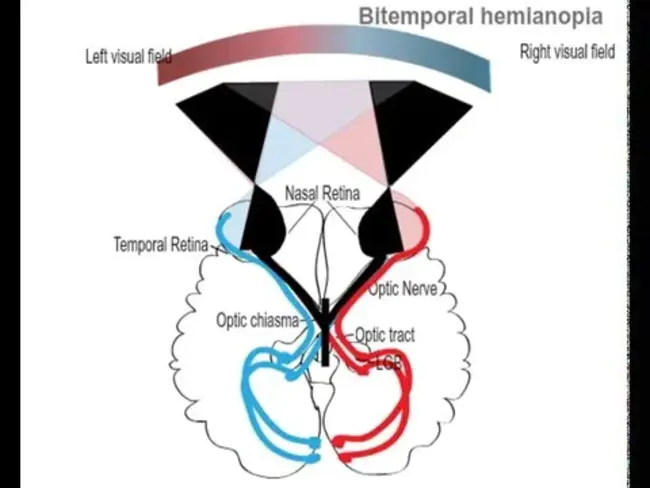 bitemporal : 双颞的