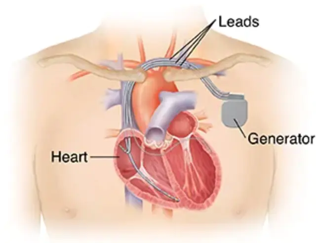 biventricular : 双心室的