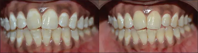 bleaching treatment–dentistry : 漂白治疗-牙科