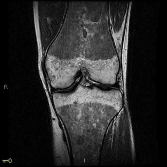 Bone Marrow Remission : 骨髓缓解