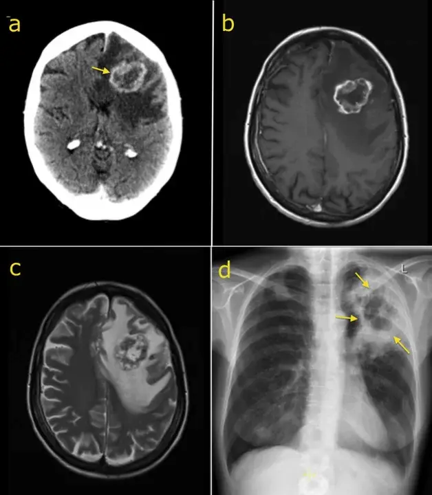 brain metastases : 脑转移