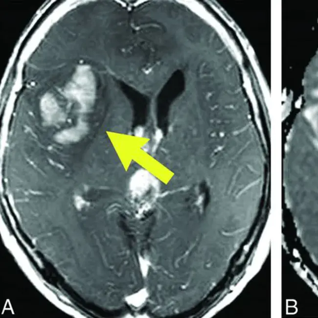 Brain Surrounding Tumour : 肿瘤周围的大脑