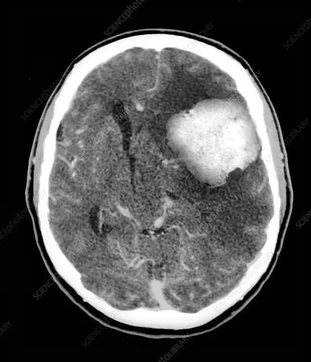 Brain Tumour : 脑肿瘤