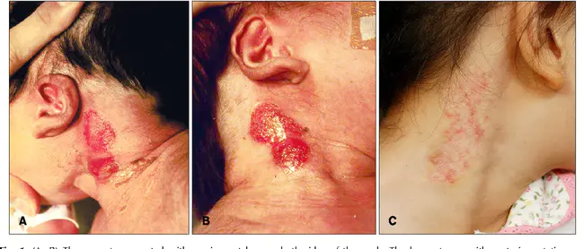 branchiooculofacial syndrome : 鳃面综合征