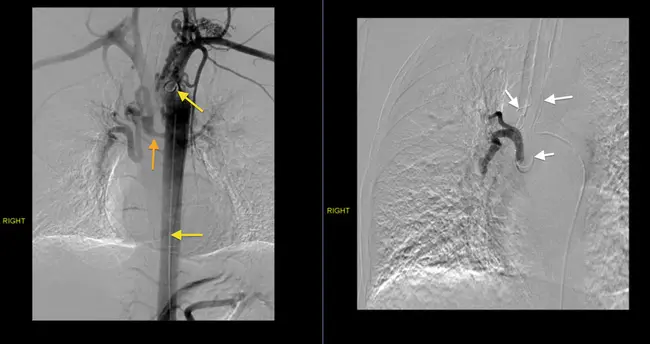 bronchial carcinoma : 支气管癌