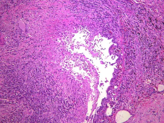 bronchocentric granulomatosis : 支气管中心性肉芽肿病