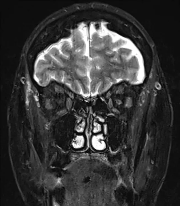 Brown Bowel Syndrome : 棕肠综合征