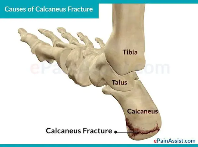 calcaneus : 跟骨