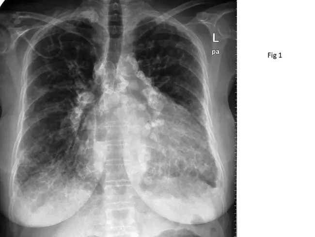 Calcified Aortic Stenosis : 钙化性主动脉狭窄