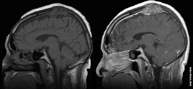 Calvarial Hyperostotic Syndrome : 颅骨增生综合征