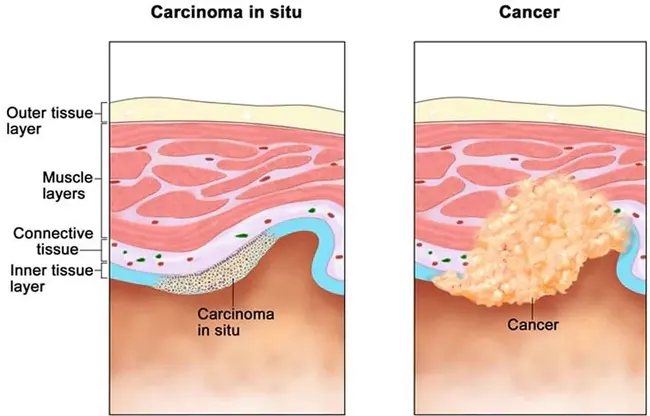 Carcinoma-In-Situ : 原位癌