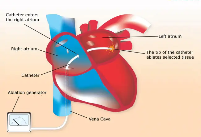 Cardiac Catheterisation : 心导管插入术