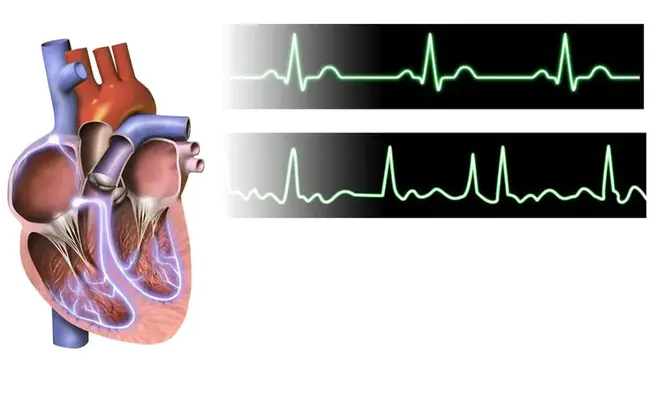 Cardiac Denervation : 心脏去神经