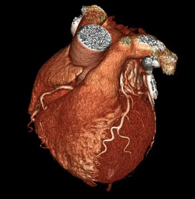 Cardiac Dysfunction : 心脏功能障碍