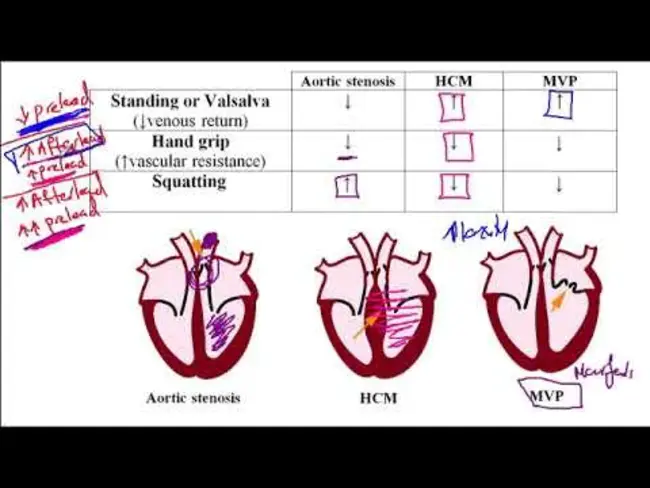 Cardiac Murmur : 心脏杂音