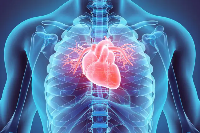 Cardiac Myxoma : 心脏粘液瘤