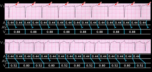 Cardiac Peak Amplitude : 心脏峰值振幅