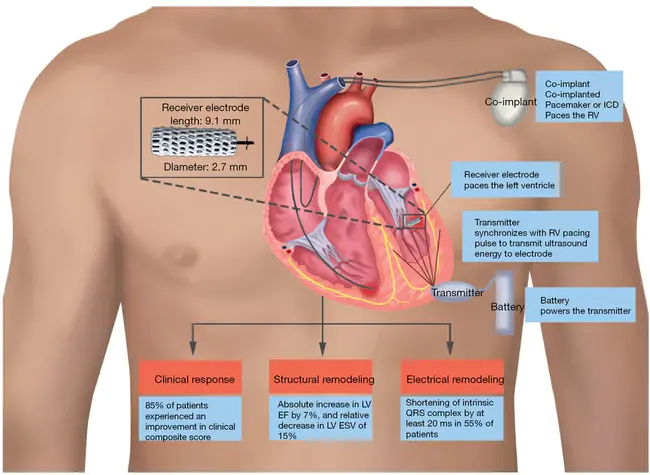 Cardiac Resynchronisation Therapy : 心脏再同步治疗