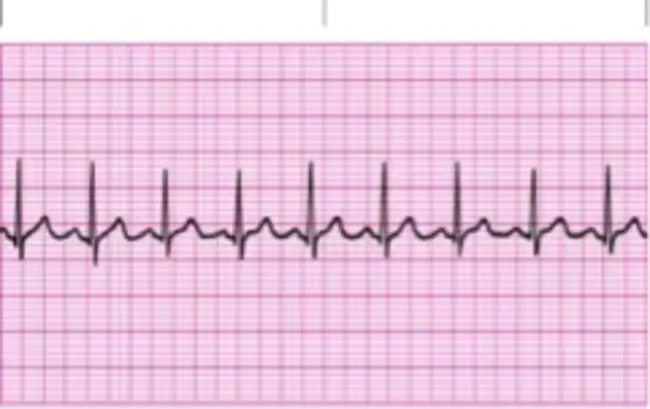 Cardiac Rhythm : 心脏节律