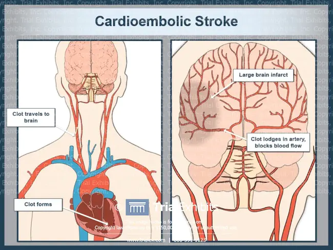 cardioembolic : 心脏栓子的